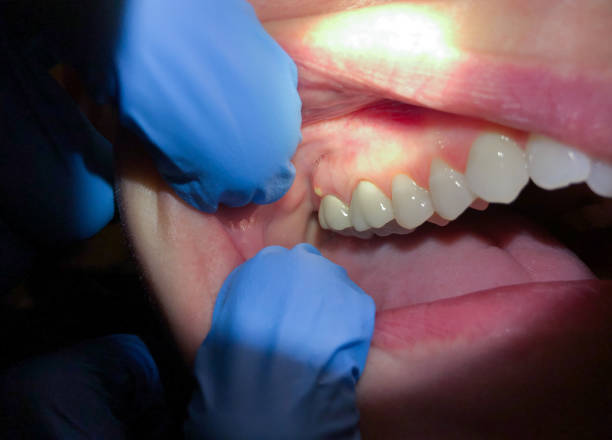 Best Emergency Treatment for Dental Infections or Abscesses in Benson, AZ